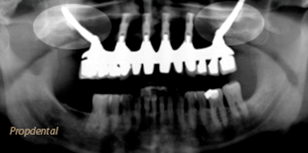 implantes zigomaticos