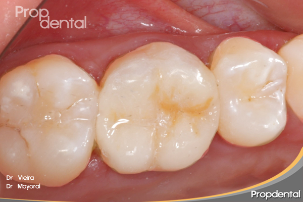 caso clinico de incrustaciones de porcelana