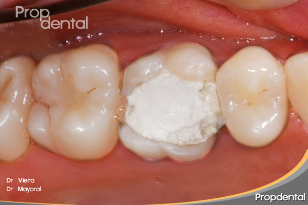 incrustación onlay para rehabilitar diente endodonciado