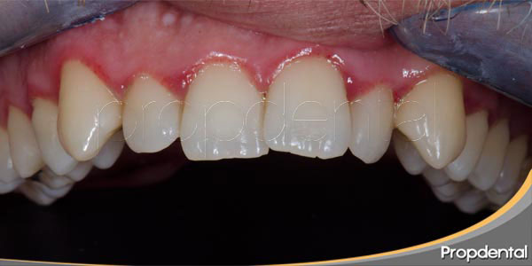 inflamación gingival