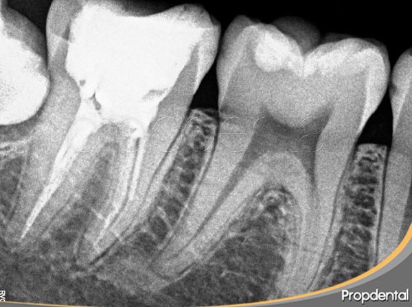 molar endodonciado