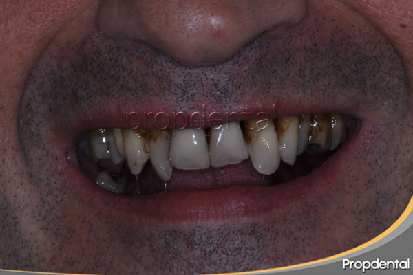 movilidad dental
