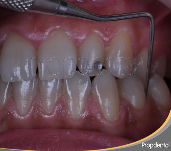 precio mantenimiento periodontal