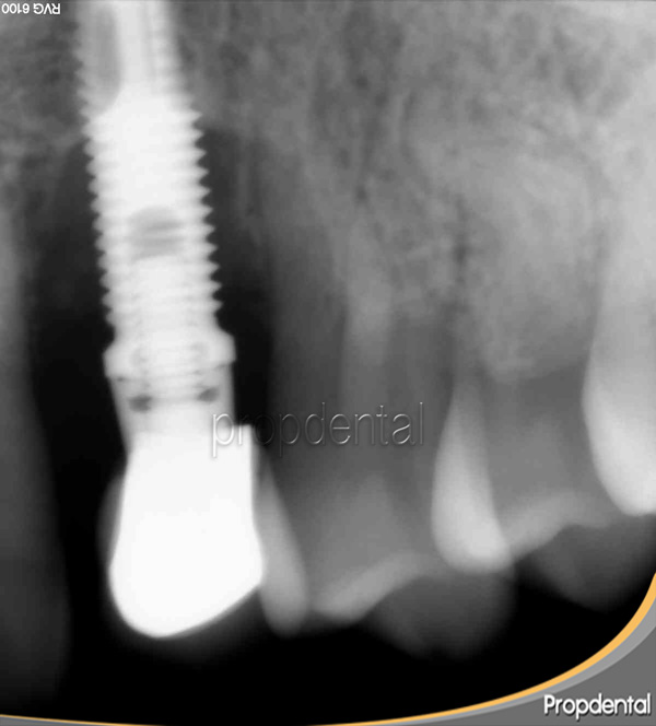 radiografía periimplantitis