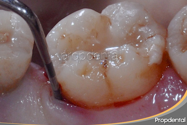 sondaje periodontal