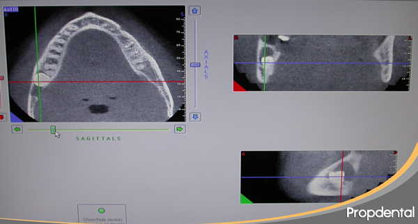 tercer molar incluido tac