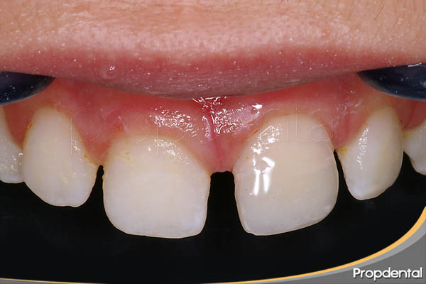 tratamiento del trauma dental