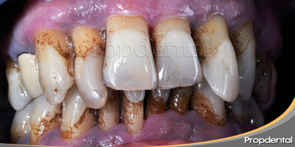 tratamiento de la enfermedad periodontal