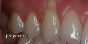 ¿Que es la Abrasión dental?