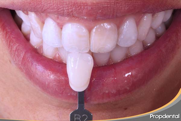 blanqueamiento dental interno