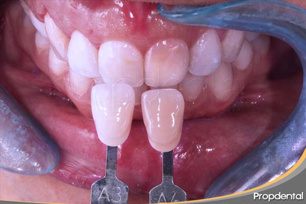 blanqueamiento dientes no vitales