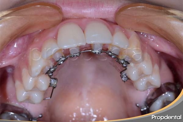 brackets-linguales-en-barcelona