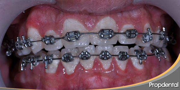 brackets metálicos para ortodoncia