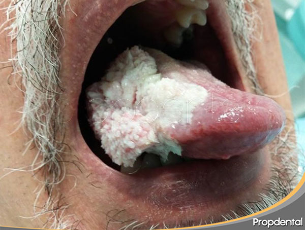 carcinoma verrucoso en la lengua