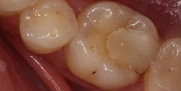 caries secundaria