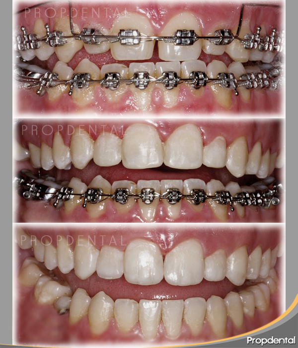 caso clínico brackets metálicos