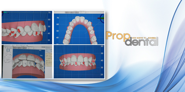 clincheck invisalign