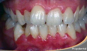 encías inflamadas