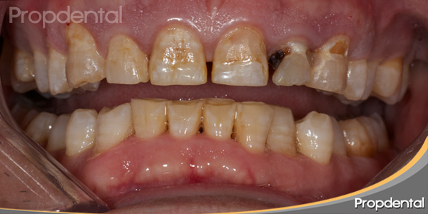 fluorosis dental