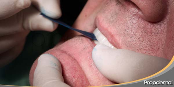 oclusion e implantes dentales