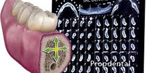 Injerto de hueso para implante dental