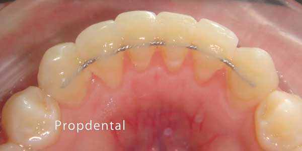retenedor fijo de ortodoncia