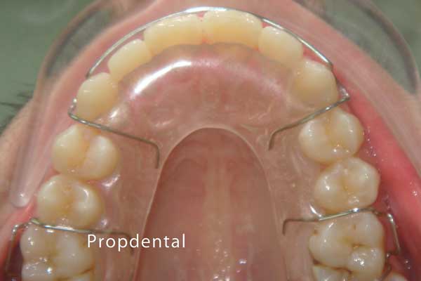 hawley retenedor removible de ortodoncia