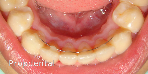 retenedores fijos de ortodoncia