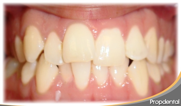 apinamiento-invisalign-antes