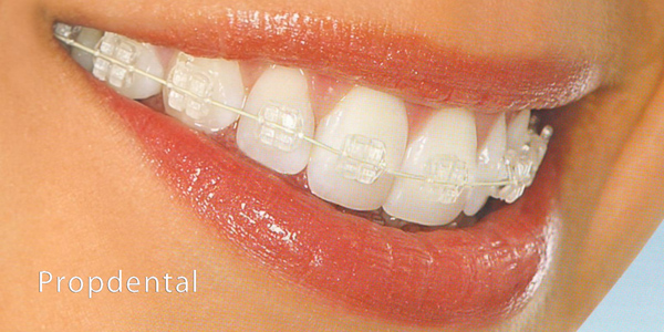 brackets cerámicos para la ortodoncia estética