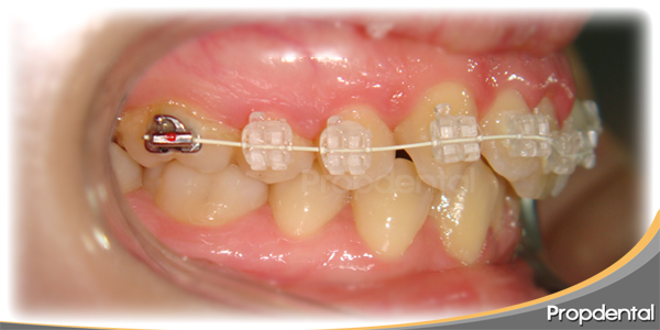 Los brackets transparentes propdental