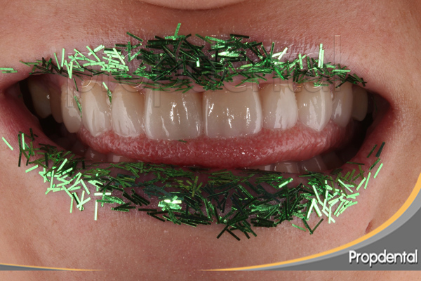 carillas dentales Badalona Propdental