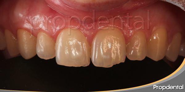 caso de carillas dentales en Barcelona