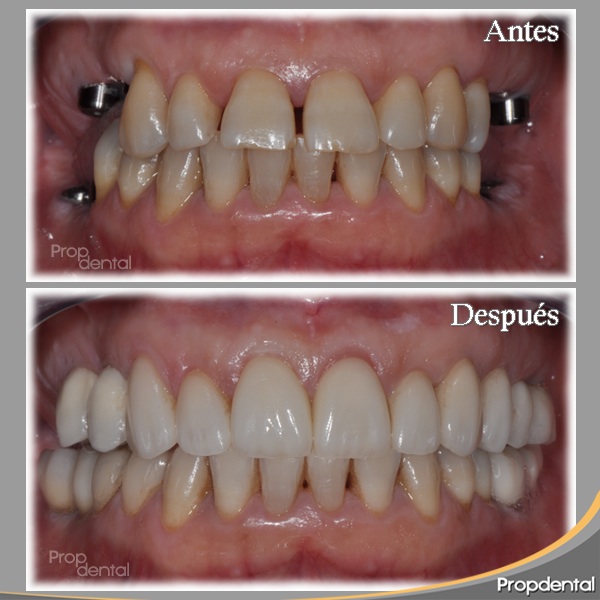 caso de implantes dentales