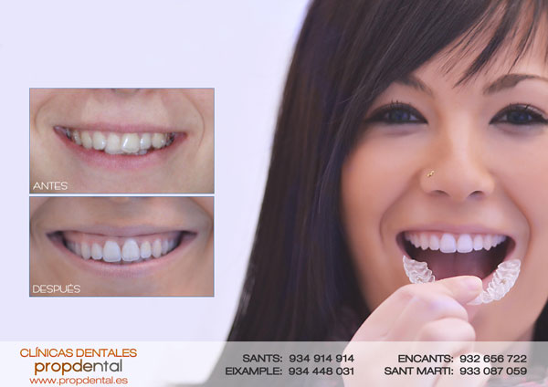 caso ortodoncia invisible propdental