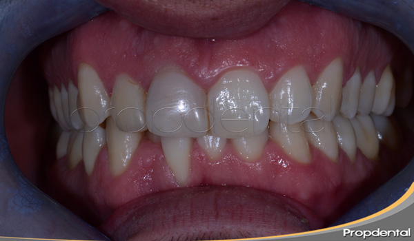 causas del apiñamiento dental