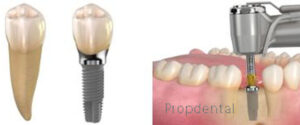 cirugía implantes dentales