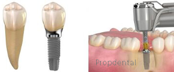 Estrecho de Bering Chelín Universidad Postoperatorio implantes dentales y tiempo de recuperación