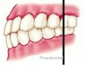 clasificación de angle de ortodoncia