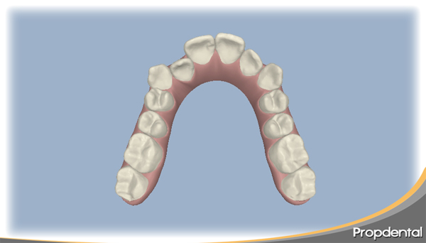 clincheck de invisalign