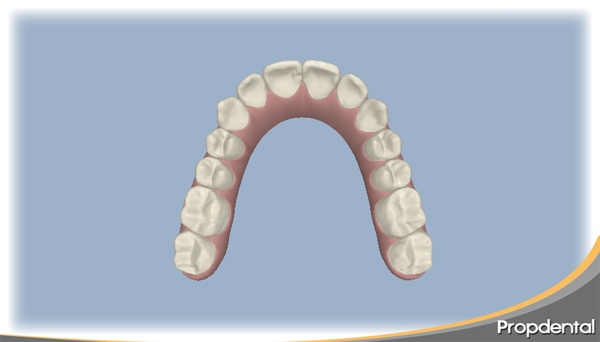 planificación del tratamiento de ortodoncia con invisalign y visualización del resultado antes de empezar