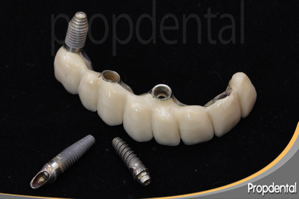 complicaciones de los implantes dentales