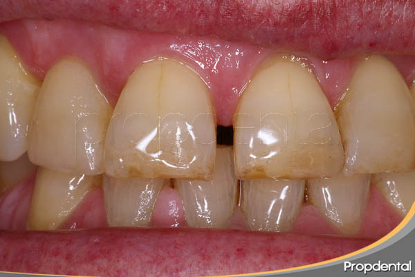 diastema interincisal