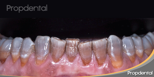 dientes tetraciclinicos