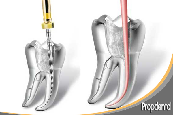 endodoncia mecanizada de un molar