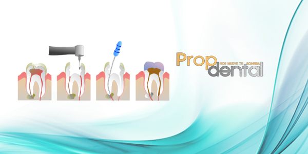 endodoncia multirradicular barcelona