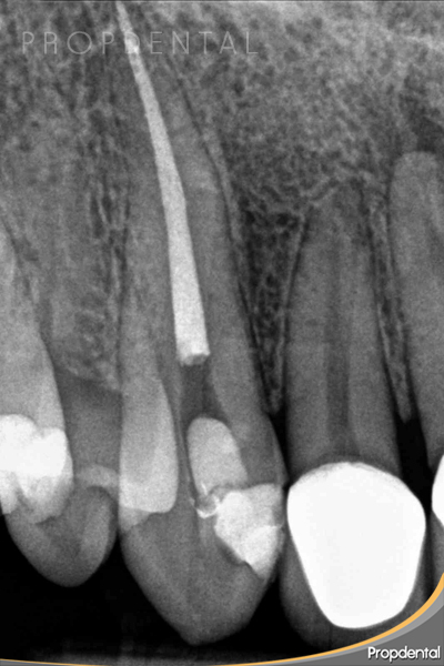 endodoncia unirradicular canino