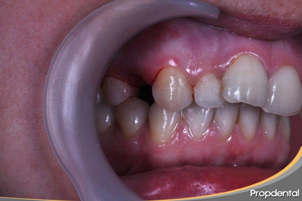 extracción premolares para ortodoncia