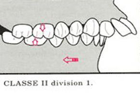 Maloclusion Clase Ii De Angle