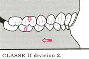 maloclusión clase 2 div 2